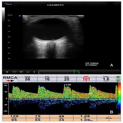 Reliability of Assessing Non-severe Elevation of Intracranial Pressure Using Optic Nerve Sheath Diameter and Transcranial Doppler Parameters